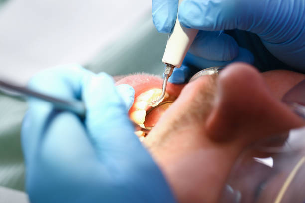 Best Emergency Tooth Extraction in Web, AL